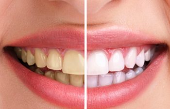 Comparison of teeth before and after surgery