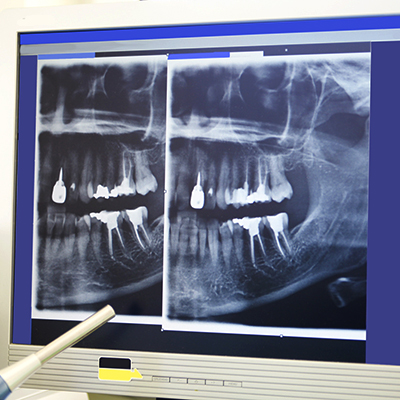 X-ray picture of teeth