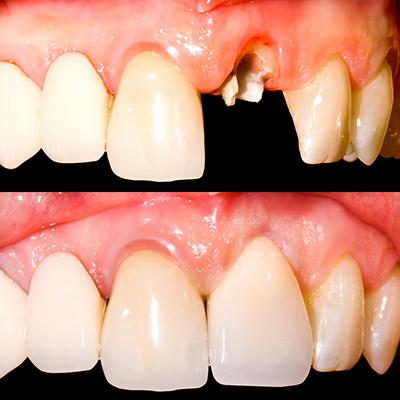 Teeth before and after insertion of the dental bridge