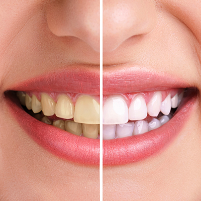 Comparison of teeth before and after surgery