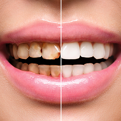 Comparison of teeth before and after surgery
