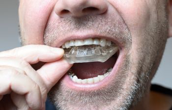 Man Inserting a Dental Mouthguard Alpharetta GA