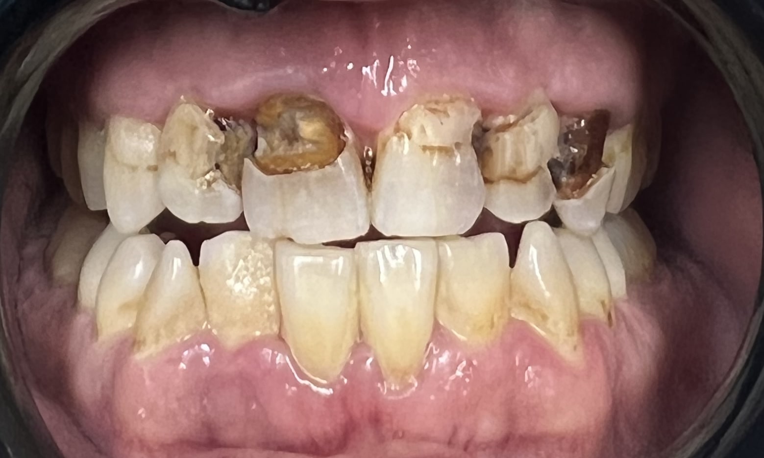 Same-Day Dental Restoration before