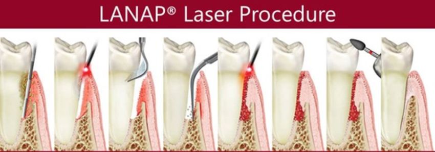LANAP Laser Procedure