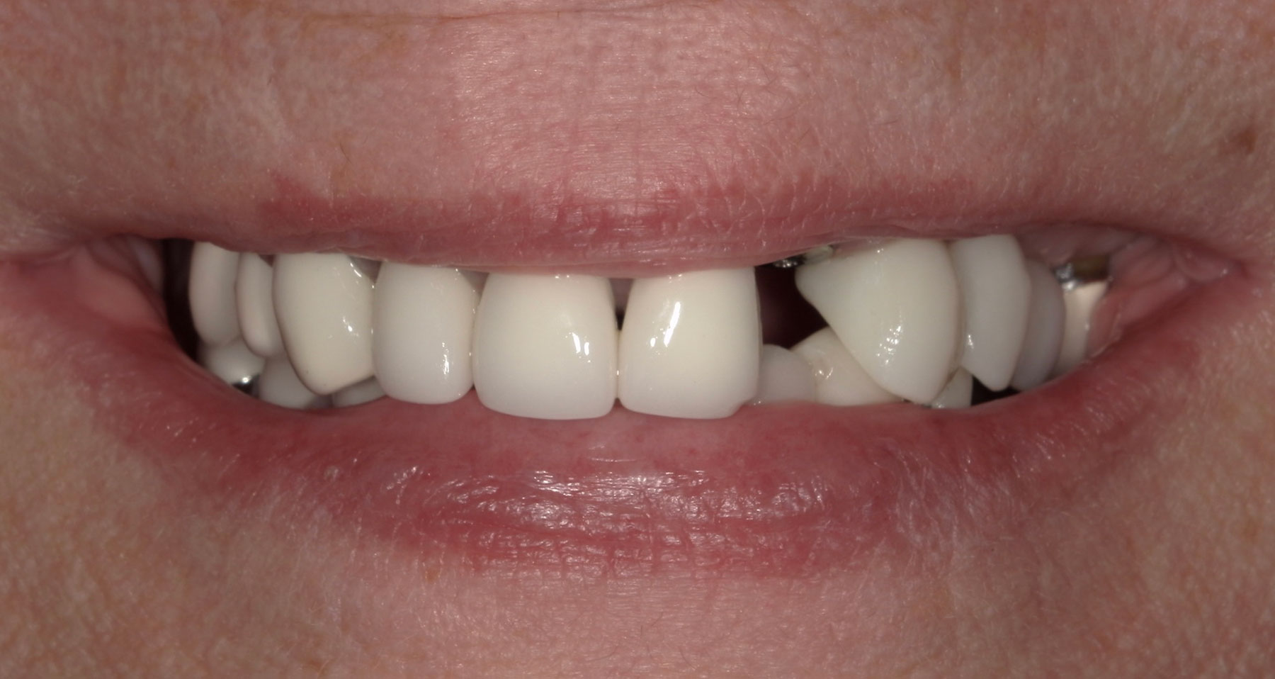 before dental implant procedure