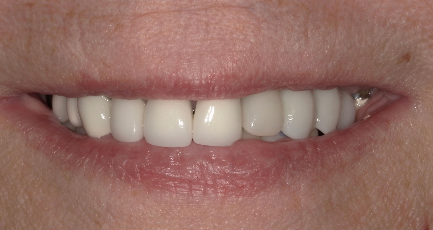 after dental implant procedure