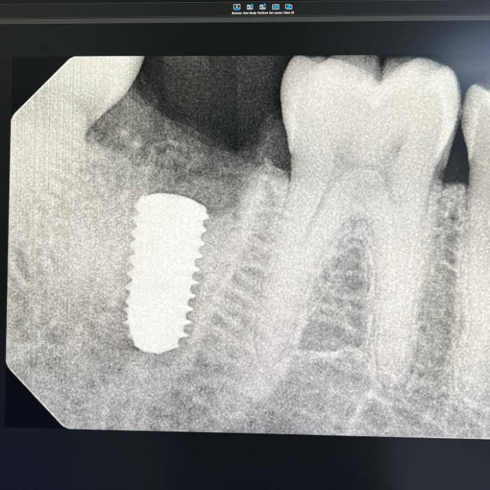Dental X-ray showing teeth and a dental implant with visible threading in the lower jaw.