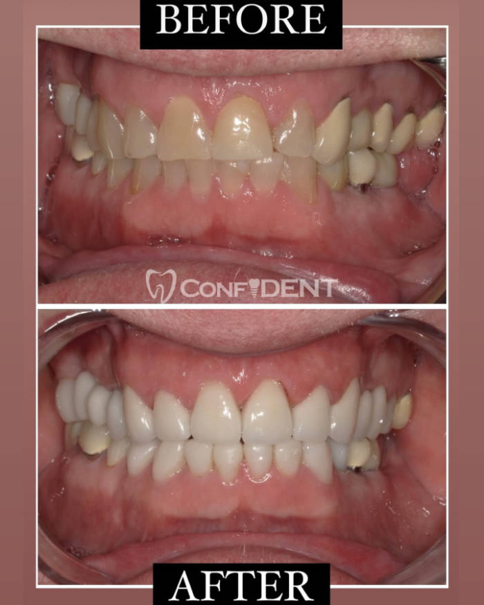 Dental before and after comparison showing crooked, discolored teeth in the top image and straight, white teeth in the bottom image, with 'Confident' dental practice branding.