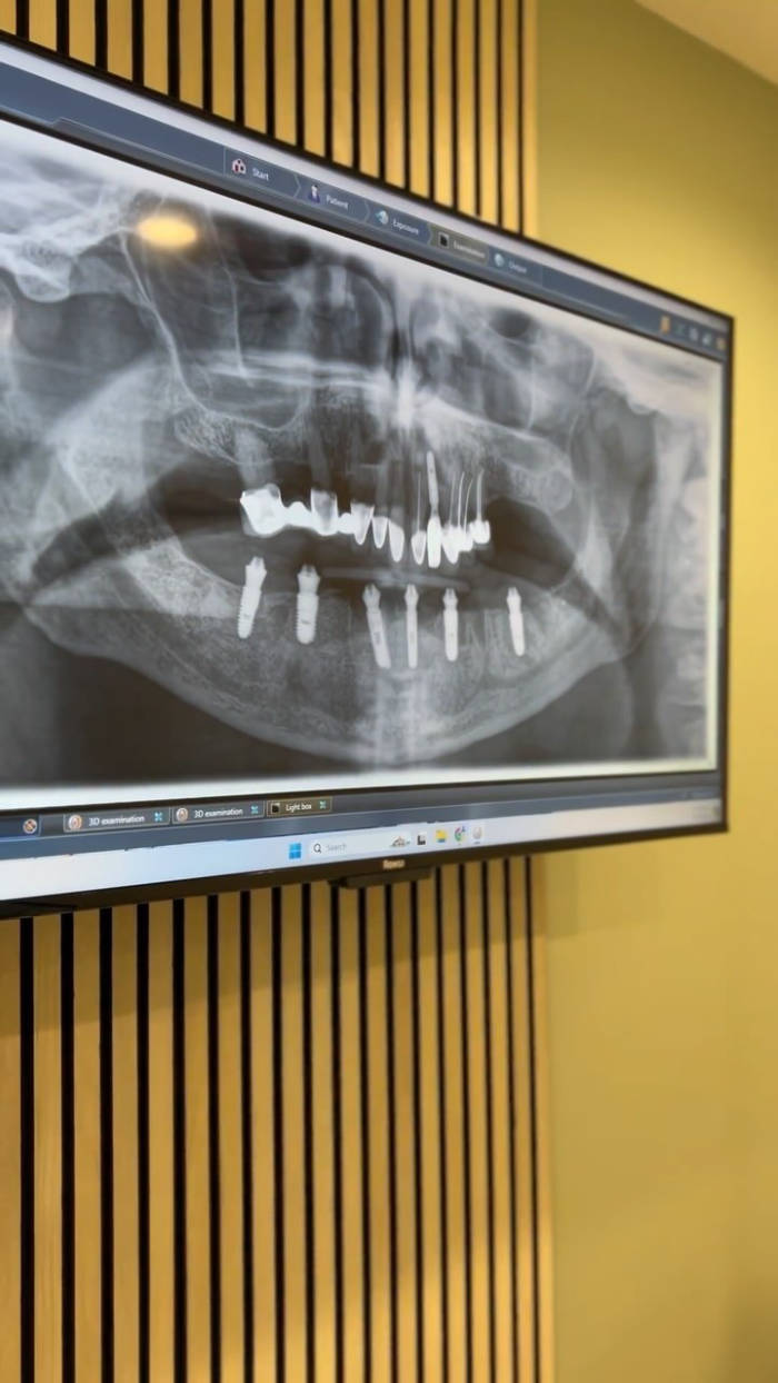 Panoramic dental X-ray displayed on a computer monitor showing full mouth view with visible dental implants and tooth structures.