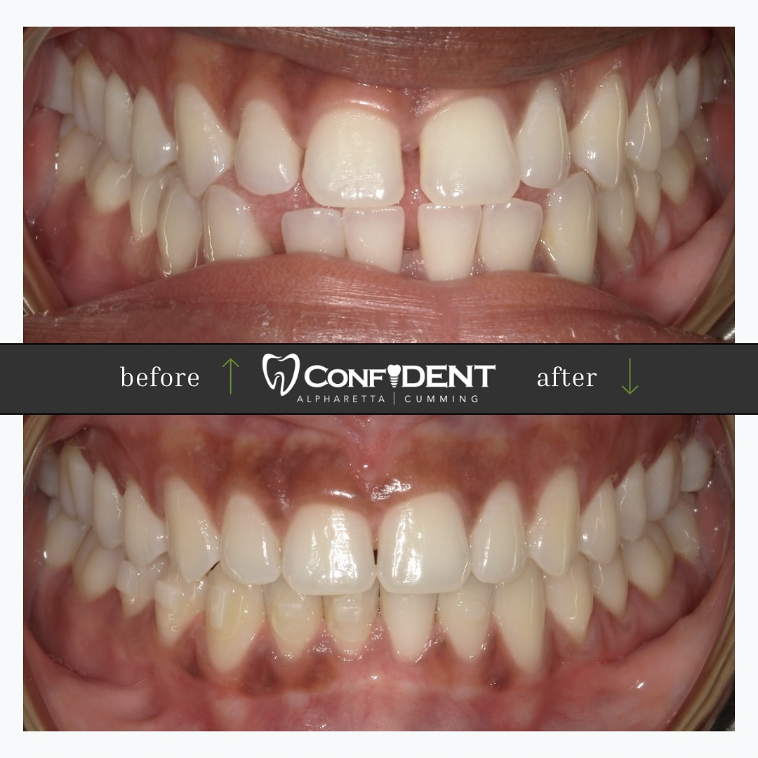Dental before and after comparison showing teeth with gaps and misalignment in the top image and improved alignment and spacing in the bottom image, branded by Confident dental practice.